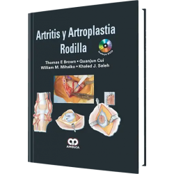 Artritis y Artroplastia Rodilla