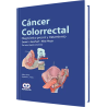 Cáncer Colorrectal