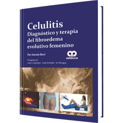 Celulitis Diagnóstico y Terapia del Fibroedema Evolutivo Femenino