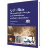 Celulitis Diagnóstico y Terapia del Fibroedema Evolutivo Femenino