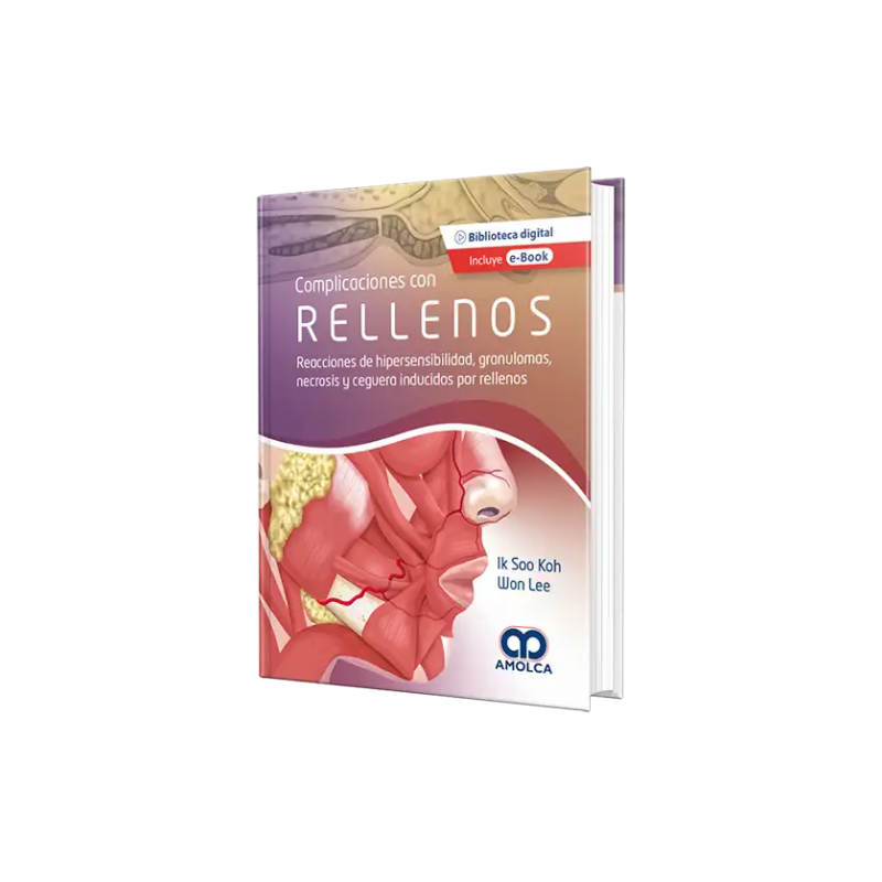 Complicaciones Con Rellenos. Reacciones de Hipersensibilidad, Granulomas, Necrosis, y Ceguera Inducidos por Rellenos