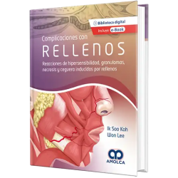 Complicaciones Con Rellenos. Reacciones de Hipersensibilidad, Granulomas, Necrosis, y Ceguera Inducidos por Rellenos